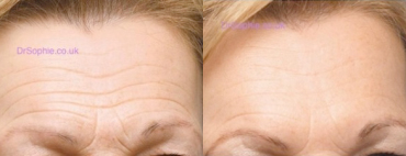 How to remove wrinkles from your forehead