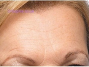 Forehead Line Removal