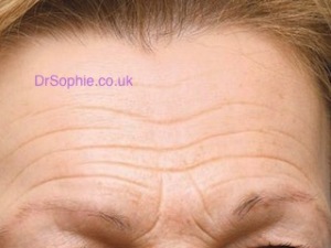 Forehead Lines Treatment