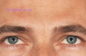 Frown Line Removal Essex
