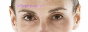 Under Eye Wrinkles Treatment Essex